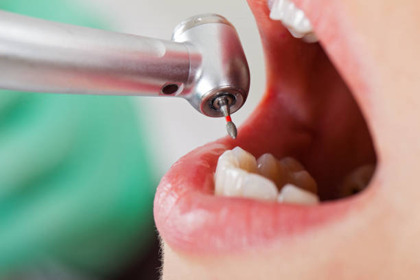 Best Emergency Dental Care for Abscessed Tooth in Aransas Pass, TX